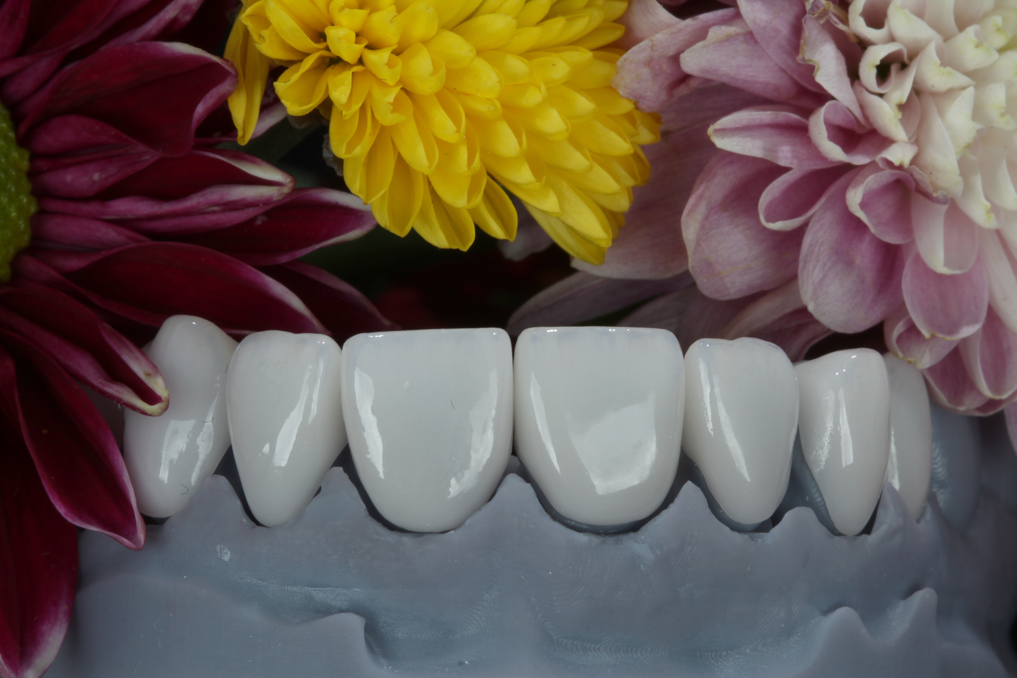 Facetas de porcelana em modelo protético