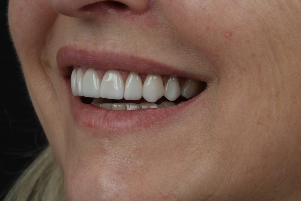 sorriso com facetas de porcelana